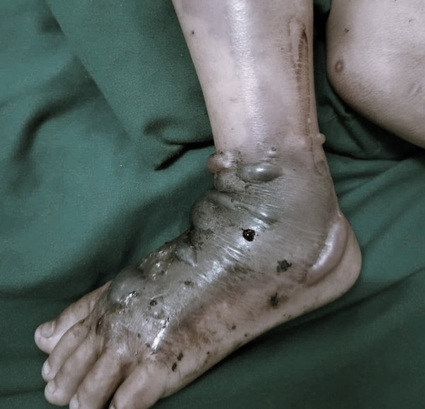 Nhiễm trùng, hoại tử do tự ý sử dụng lá cây, thuốc nam đắp vết thương