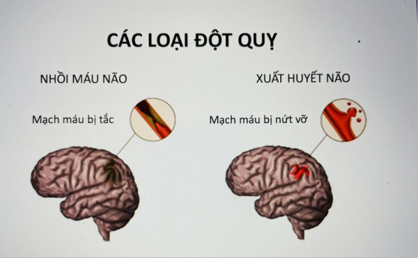 Đột qụy não – báo động đỏ