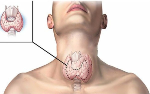 5 cách cải thiện bướu cổ lành tính an toàn và hiệu quả